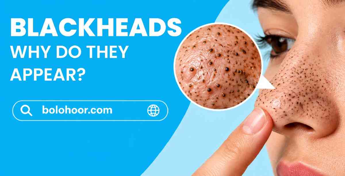 Blackheads