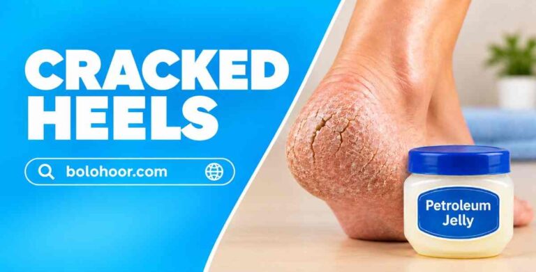 Cracked Heels